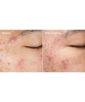 Murad Deep Relief Blemish Treatment