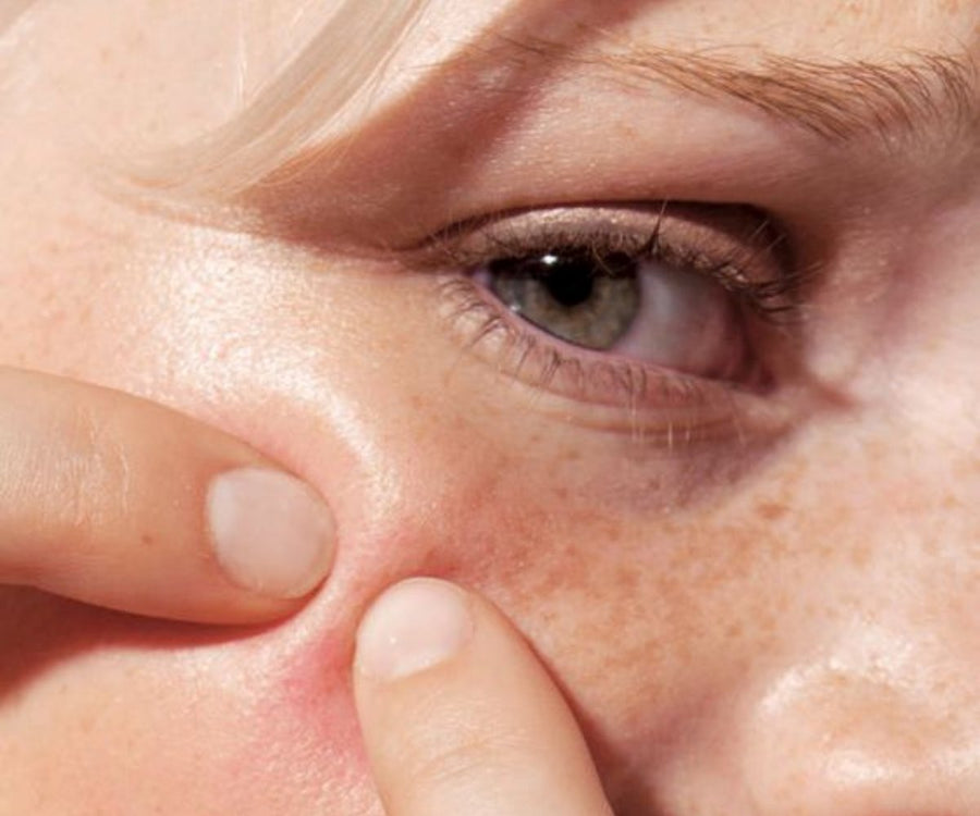 How to pop a pimple with minimal damage
