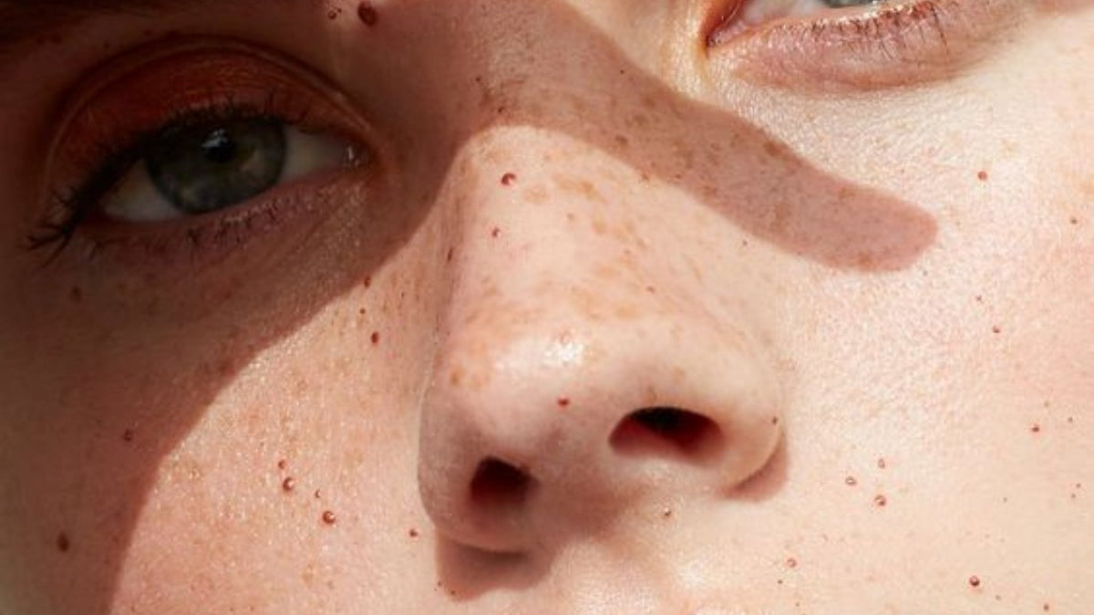 The best skincare ingredients for acne-prone skin