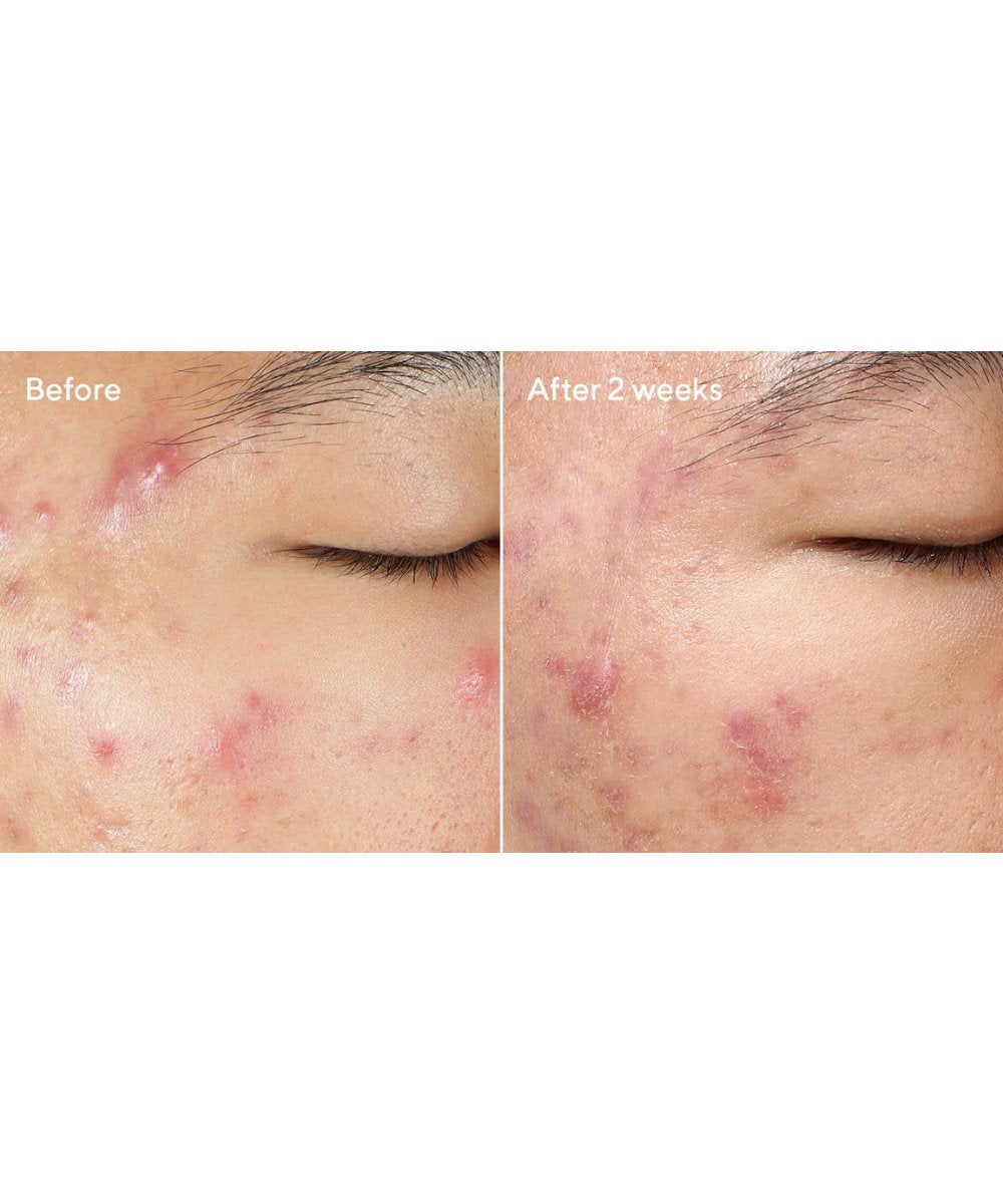 Murad Deep Relief Blemish Treatment 