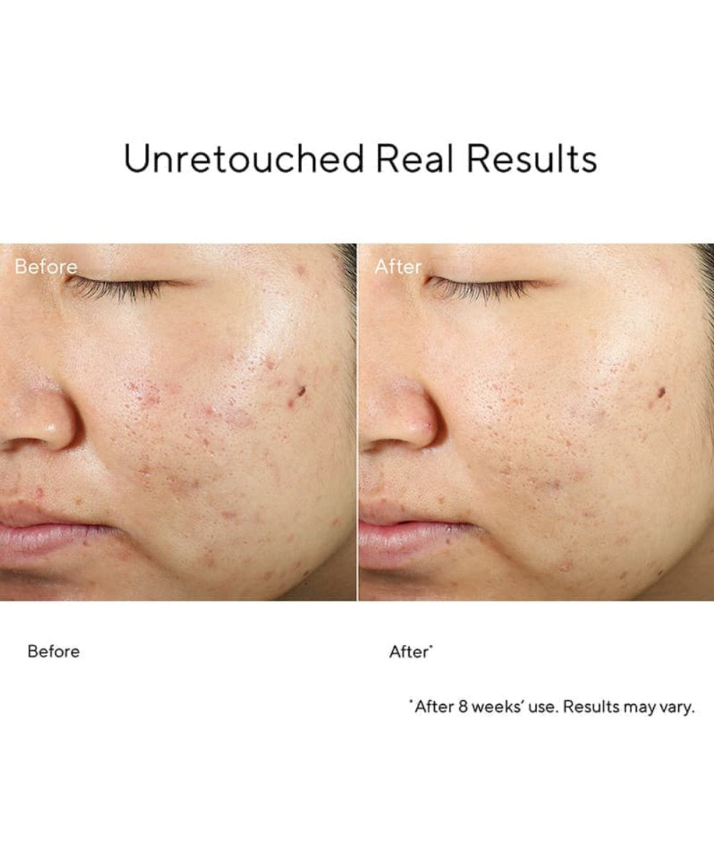 Murad Invisiscar Resurfacing Treatment 